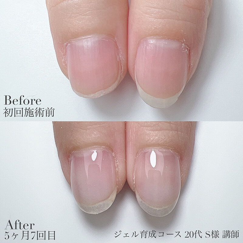 20代 S様 5ヶ月7回目