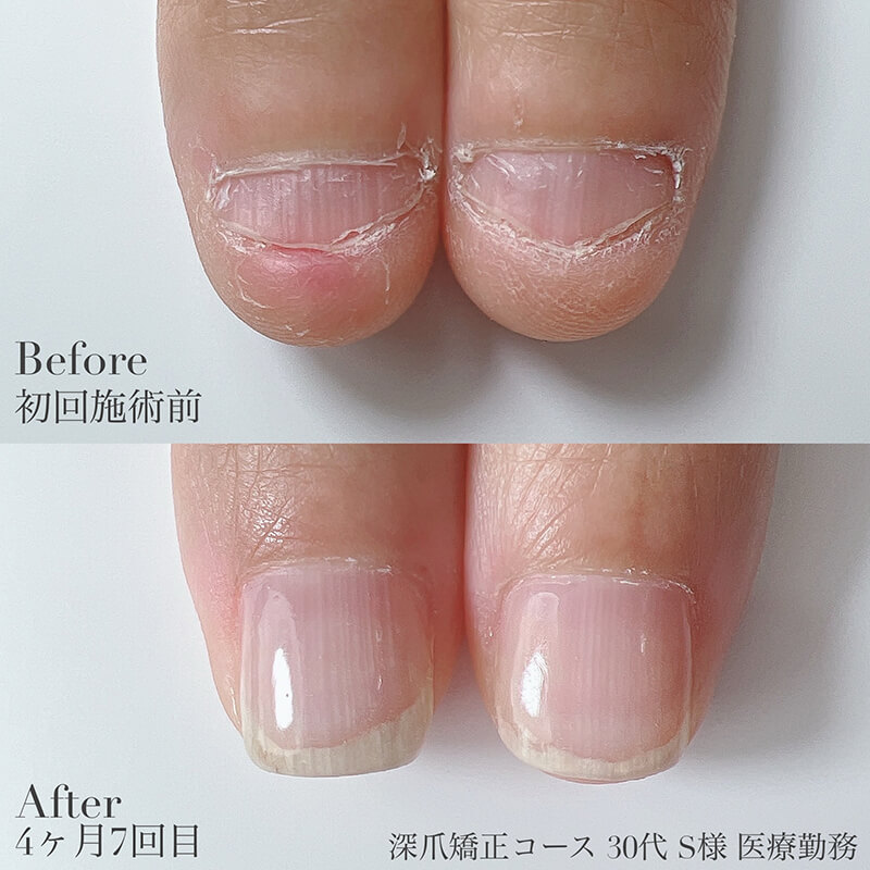 30代 S様 4ヶ月7回目